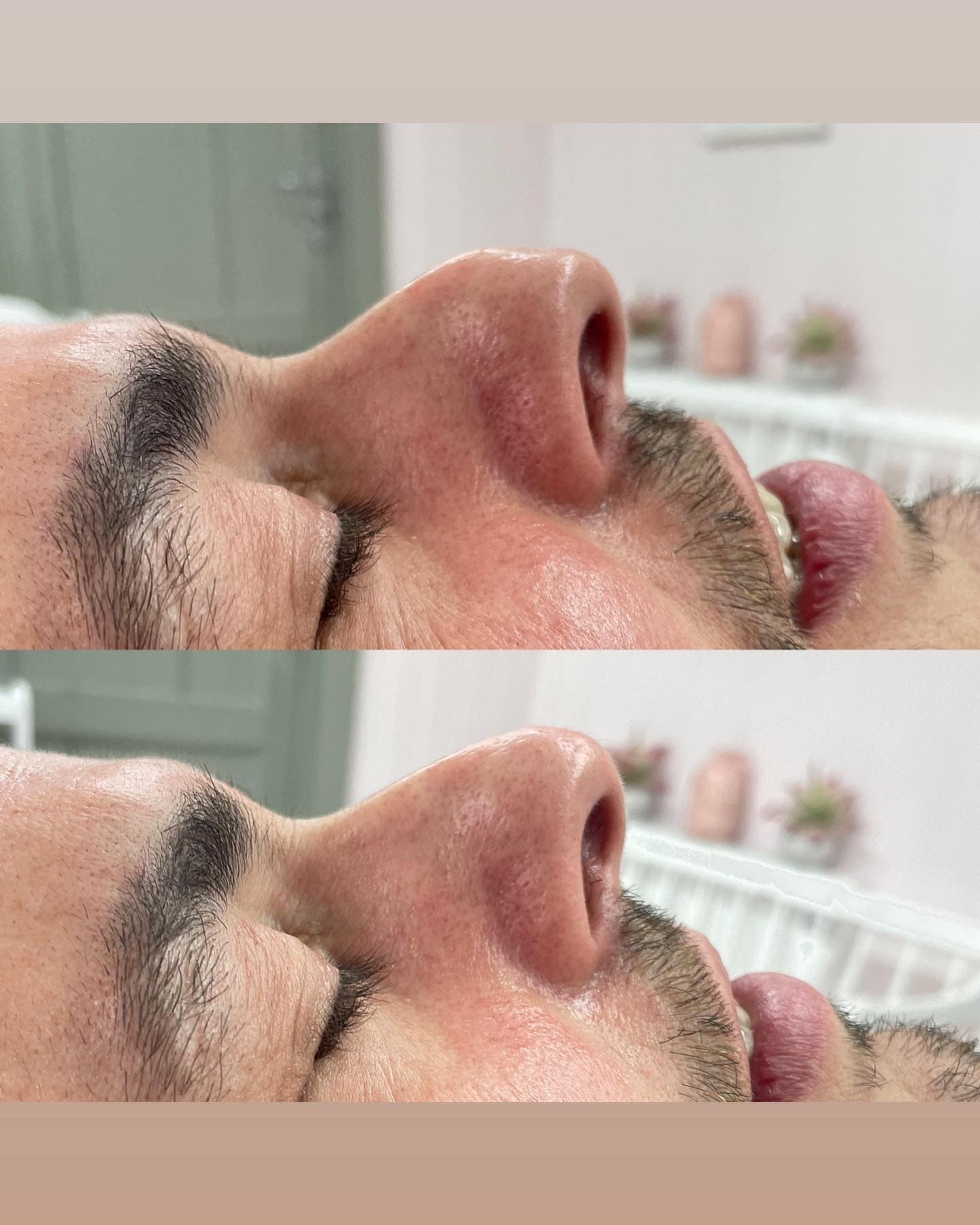 Before and after aesthetic treatment results at Loft Aesthetics clinic