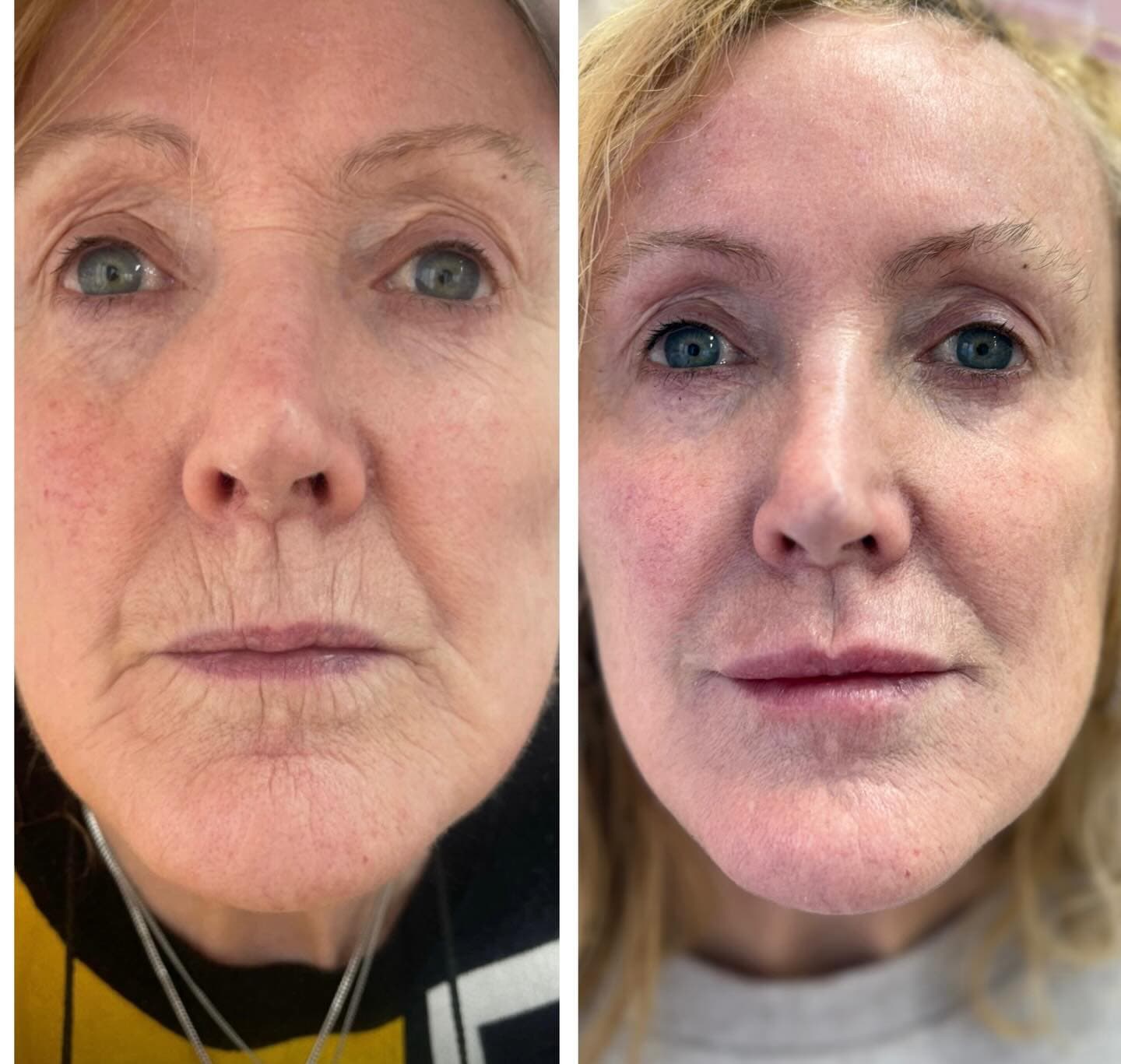 Before and after aesthetic treatment results at Loft Aesthetics clinic