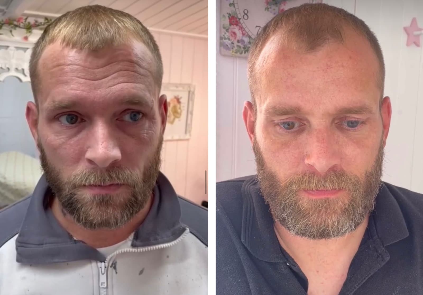 Before and after aesthetic treatment results at Loft Aesthetics clinic