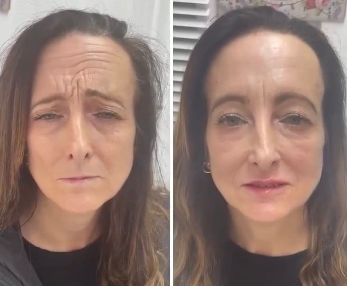 Before and after aesthetic treatment results at Loft Aesthetics clinic